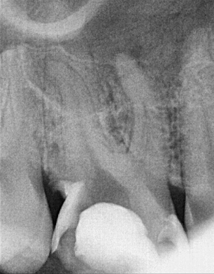 Zdjęcie zęba przed leczeniem kanałowym