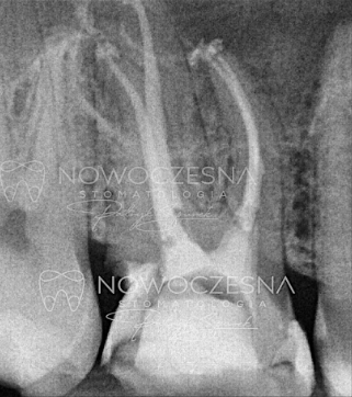 Zdjęcie zęba po leczeniu kanałowym u Doktora Patryka Spurka