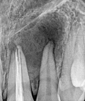 Zdjęcie zęba przed leczeniem kanałowym z rozległym stanem zapalnym