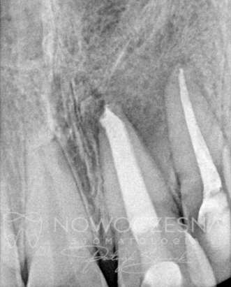 Zdjęcia zęba z rozległym stanem zapalnym po leczeniu kanałowym u Doktora Patryka Spurka