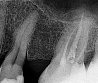 Zdjęcie zęba przed powtórnym leczeniem kanałowym