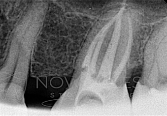 Zdjęcie zęba po powtórnym leczeniu kanałowym u Doktora Patryka Spurka