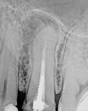 Zdjęcie zęba przed leczeniem kanałowym z obecnym wkładem protetycznym