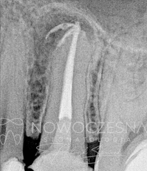 Zdjęcie zęba po leczeniu kanałowym z obecnym wkładem protetycznym u Doktora Patryka Spurka